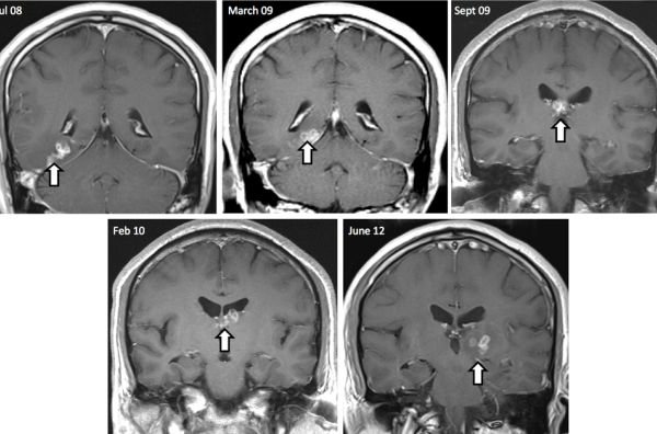 کرم 40 میلی‌متری در مغز یک مرد!/عکس