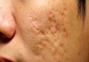 بروز آکنه در نتیجه مصرف برخی مکمل‌های ورزشی