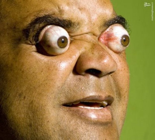 مردی که چشمانش را 4 سانتی متر بیرون می آورد/عکس