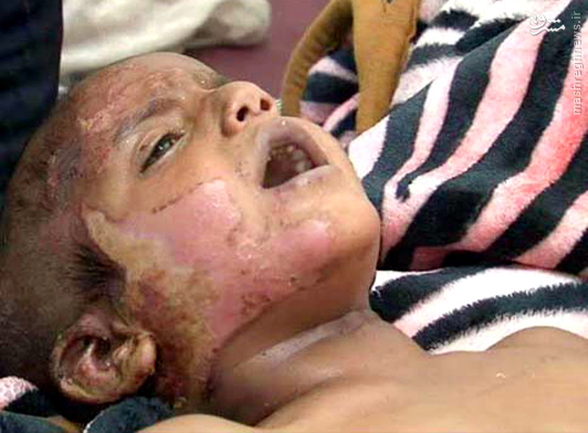 مجروحیت کودک یمنی در بمباران صعده/عکس