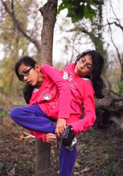 زندگی دوقلوهای به هم چسبیده+تصاویر