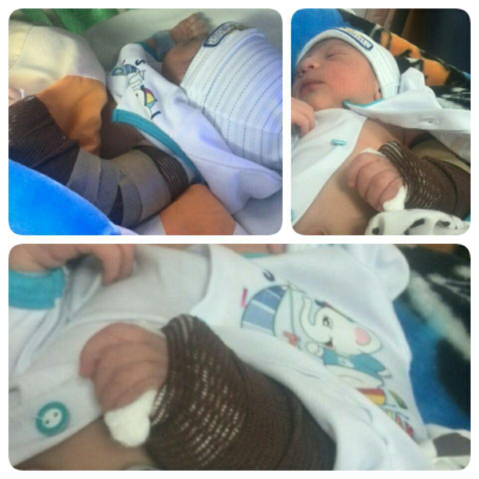 شکسته شدن بازوی نوزاد اصفهانی در حین زایمان/ عکس