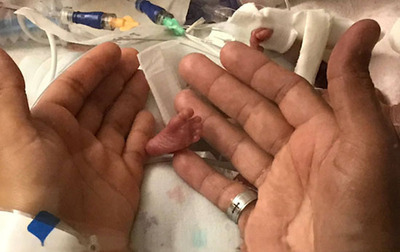 این نوزاد فقط ۳۰۰ گرم وزن دارد! اما حالش خوب است و صدا می‌کند