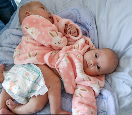 تصاویر/ جدا‌سازی دو‌قلوهای چینی